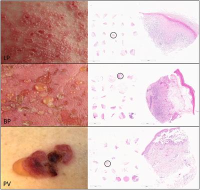 Skin-infiltrating T cells display distinct inflammatory signatures in lichen planus, bullous pemphigoid and pemphigus vulgaris